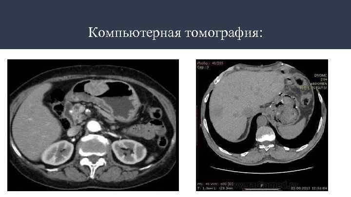 Компьютерная томография: 