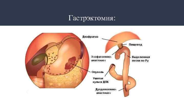 Гастрэктомия: 