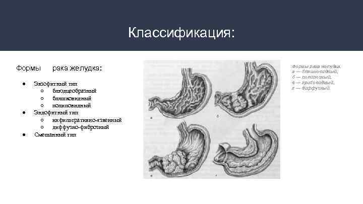 Классификация: Формы ● ● ● рака желудка: Экзофитный тип ○ блюдцеобразный ○ бляшковидный ○