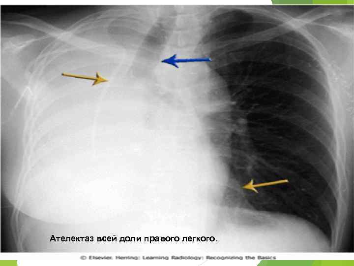 Ателектазы рентген схема