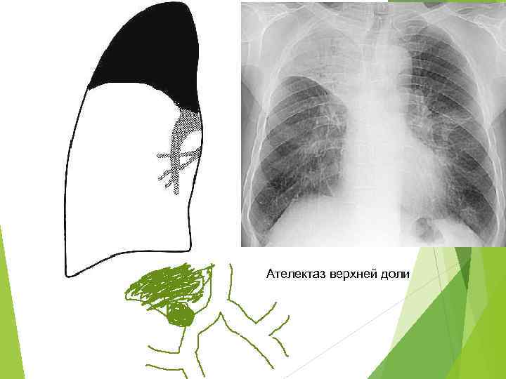 Отсутствие легочного рисунка