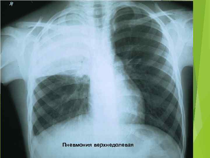 Фото рентгена легких при коронавирусе фото