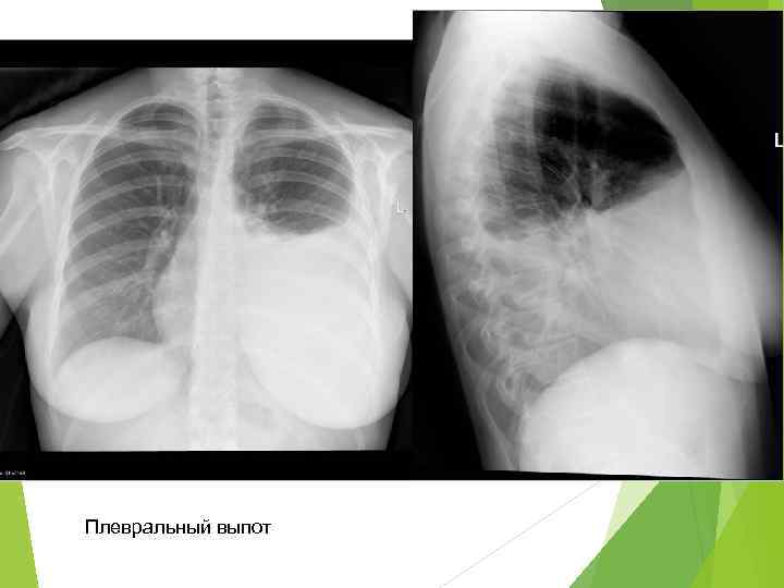 Жидкость гидроторакс. Гидроторакс на рентгенограмме. Плеврит рентген. Плевральный выпот и гидроторакс. Осумкованный гидроторакс.