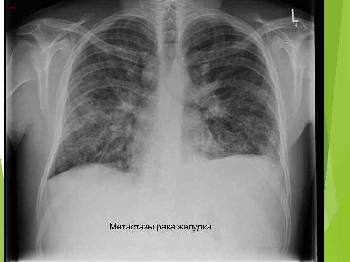 Рак легких 4. Онкология желудка с метастазами. Опухоль желудка метастазирование. Метастазы опухоли желудка.