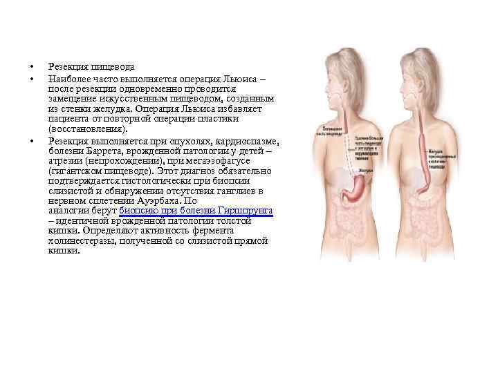  • • • Резекция пищевода Наиболее часто выполняется операция Льюиса – после резекции