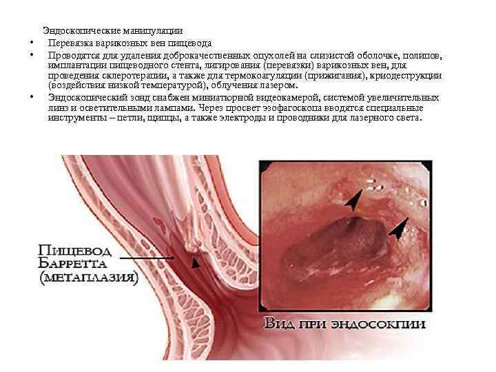  Эндоскопические манипуляции • Перевязка варикозных вен пищевода • Проводятся для удаления доброкачественных опухолей