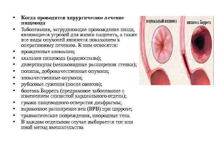  • • • • Когда проводится хирургическое лечение пищевода Заболевания, затрудняющие прохождение пищи,