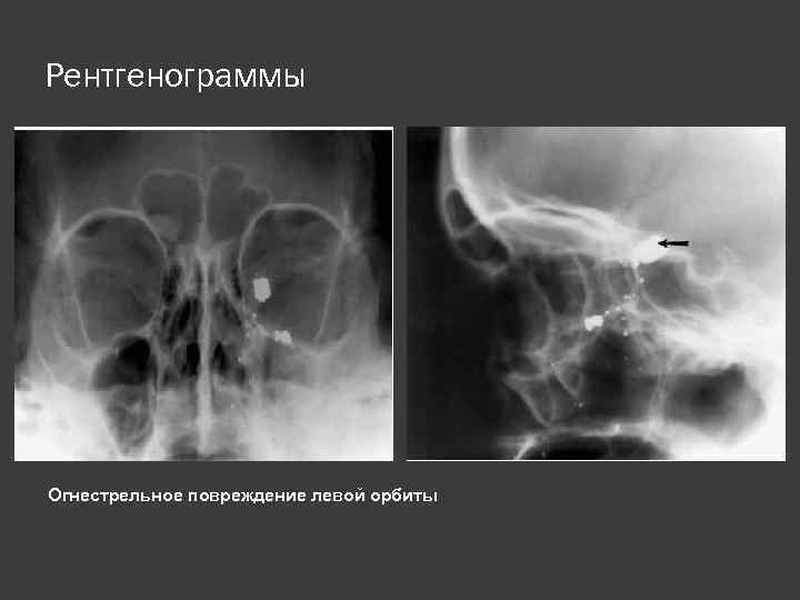 Рентгенограммы Огнестрельное повреждение левой орбиты 