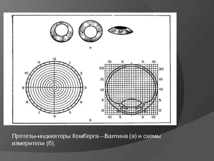 Протезы-индикаторы Комберга—Балтина (а) и схемы измерители (б). 