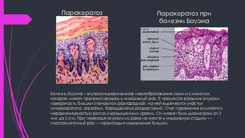 Паракератоз при болезни Боуэна Болезнь Боуэна – внутриэпидермальное новообразование кожи и слизистых, которое может