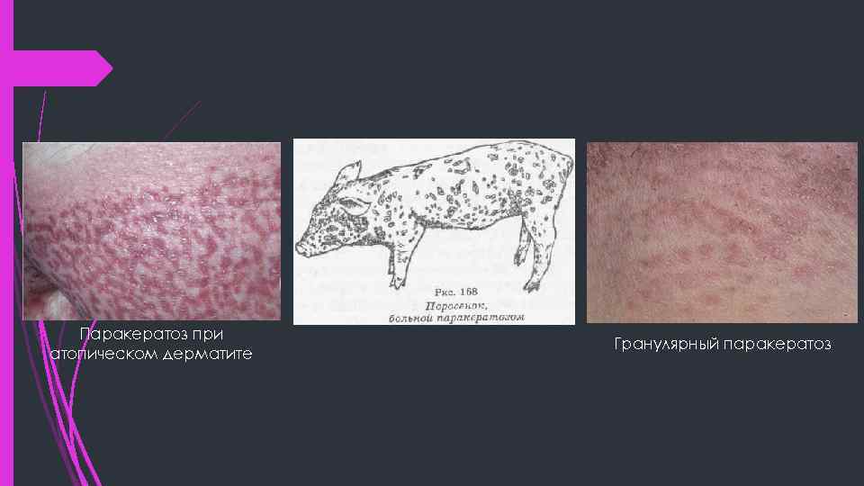 Паракератоз при атопическом дерматите Гранулярный паракератоз 