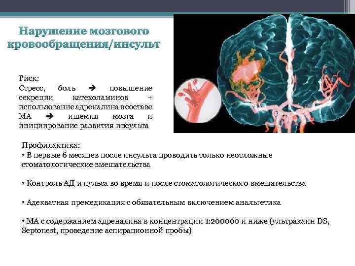 Нарушение мозгового кровообращения/инсульт Риск: Стресс, боль повышение секреции катехоламинов + использование адреналина в составе