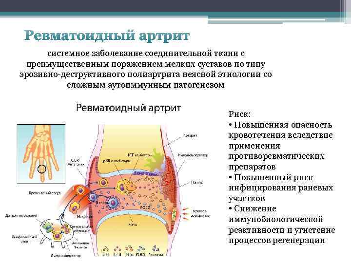 Ревматоидный артрит системное заболевание соединительной ткани с преимущественным поражением мелких суставов по типу эрозивно