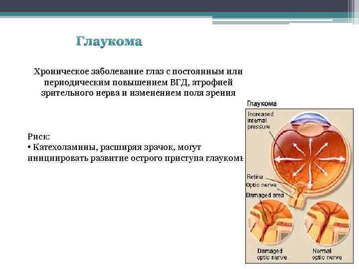 Глаукома Хроническое заболевание глаз с постоянным или периодическим повышением ВГД, атрофией зрительного нерва и