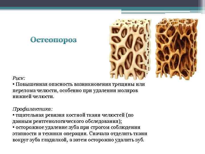 Остеопороз Риск: • Повышенная опасность возникновения трещины или перелома челюсти, особенно при удалении моляров