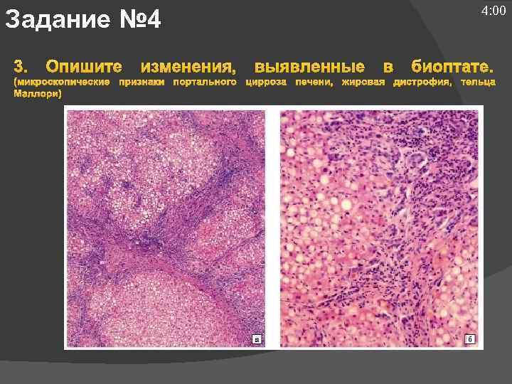 4: 00 Задание № 4 3. Опишите изменения, выявленные в биоптате. (микроскопические признаки портального
