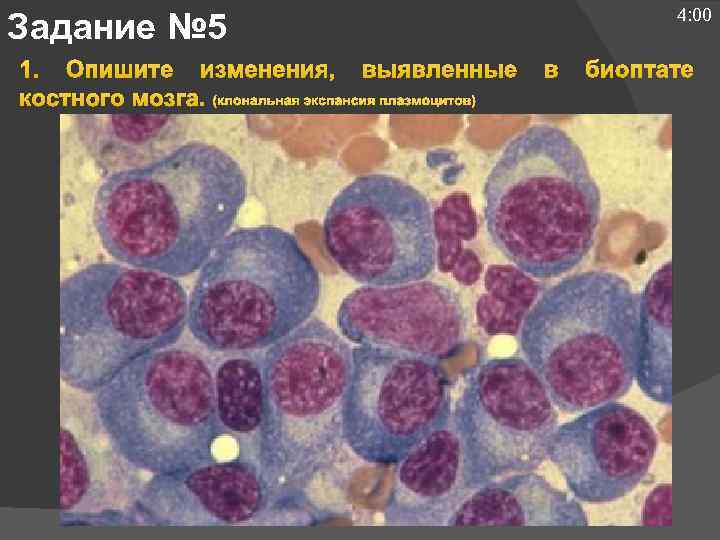 4: 00 Задание № 5 1. Опишите изменения, выявленные костного мозга. (клональная экспансия плазмоцитов)