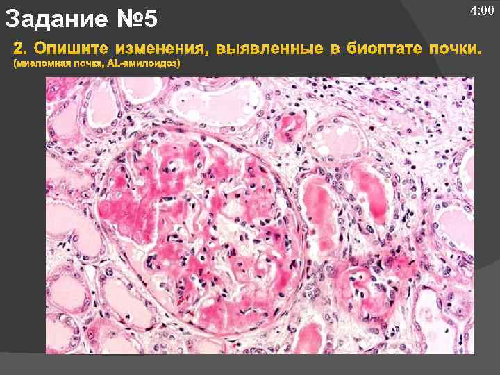 Задание № 5 4: 00 2. Опишите изменения, выявленные в биоптате почки. (миеломная почка,