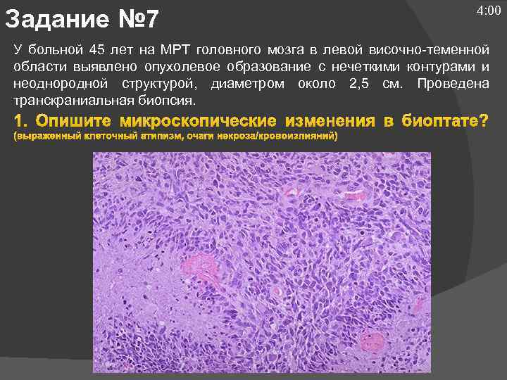 Задание № 7 4: 00 У больной 45 лет на МРТ головного мозга в