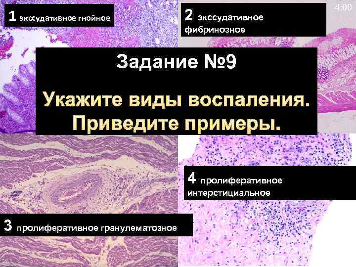 1 экссудативное гнойное 2 экссудативное фибринозное Задание № 9 Укажите виды воспаления. Приведите примеры.