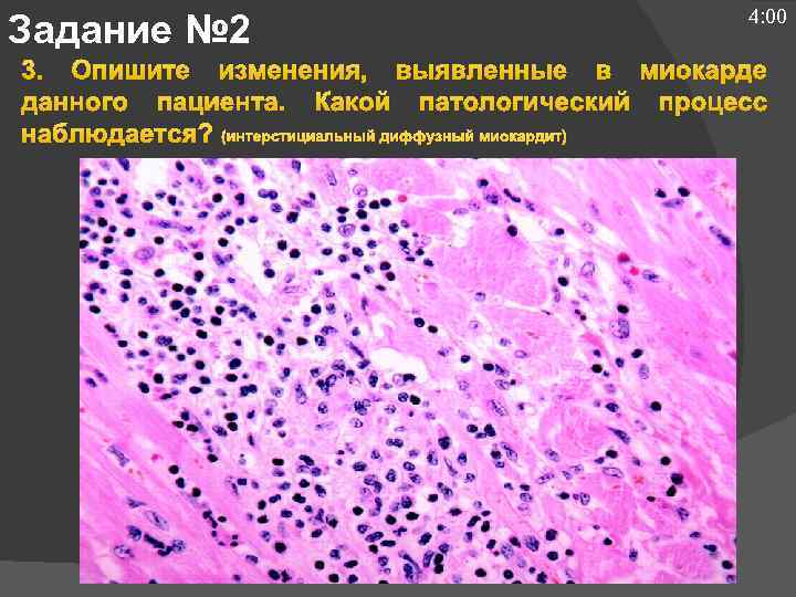 Задание № 2 4: 00 3. Опишите изменения, выявленные в миокарде данного пациента. Какой