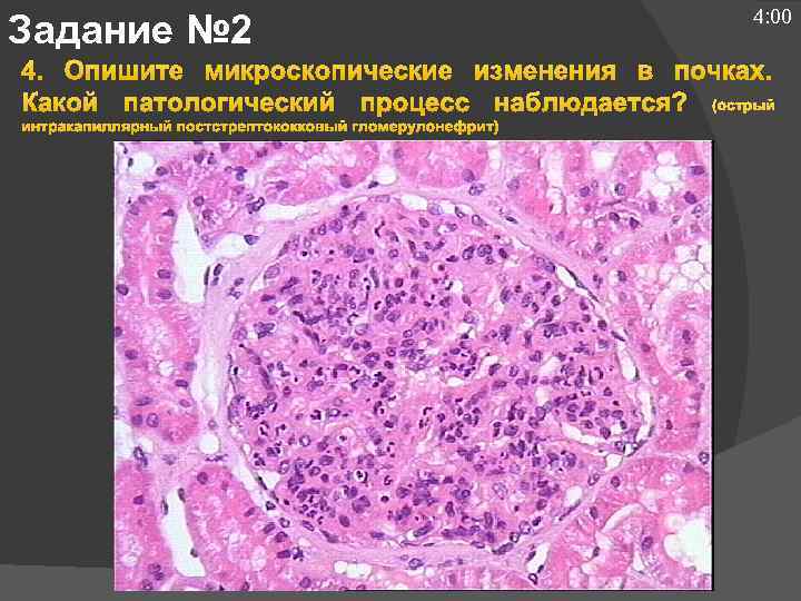Задание № 2 4: 00 4. Опишите микроскопические изменения в почках. Какой патологический процесс