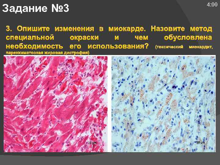 Задание № 3 4: 00 3. Опишите изменения в миокарде. Назовите метод специальной окраски