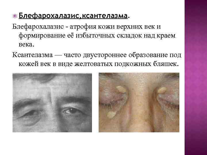  Блефарохалазис, ксантелазма. Блефарохалазис - атрофия кожи верхних век и формирование её избыточных складок