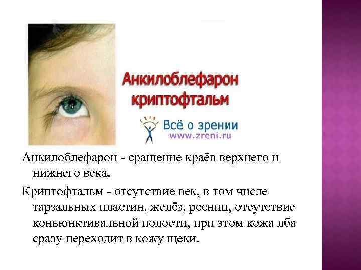 Анкилоблефарон - сращение краёв верхнего и нижнего века. Криптофтальм - отсутствие век, в том