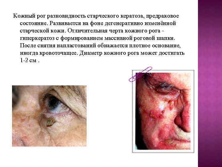 Кожный рог разновидность старческого кератоза, предраковое состояние. Развивается на фоне дегенеративно изменённой старческой кожи.