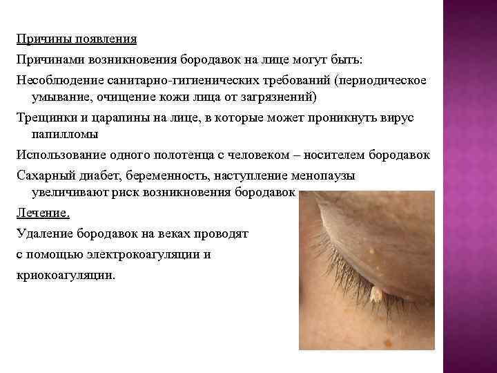 Причины появления Причинами возникновения бородавок на лице могут быть: Несоблюдение санитарно-гигиенических требований (периодическое умывание,