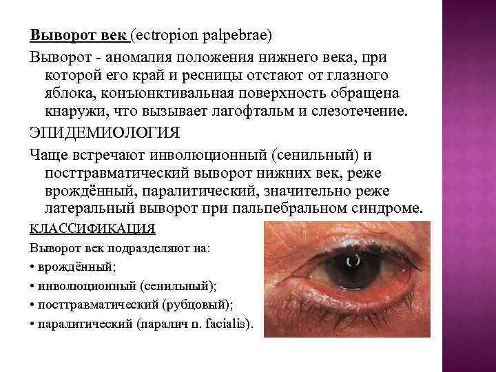 Выворот век (ectropion palpebrae) Выворот - аномалия положения нижнего века, при которой его край