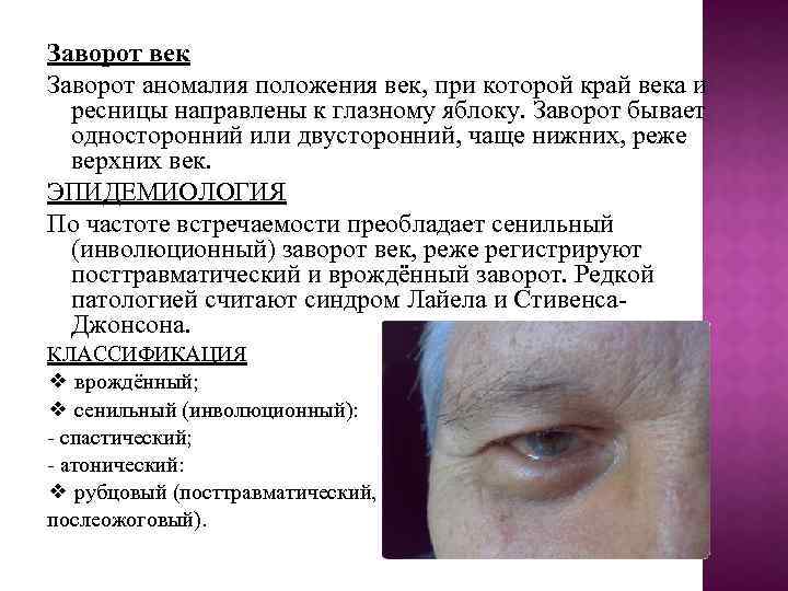 Заворот век Заворот аномалия положения век, при которой край века и ресницы направлены к