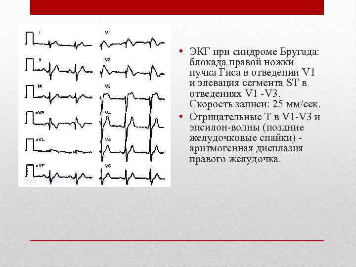  • ЭКГ при синдроме Бругада: блокада правой ножки пучка Гиса в отведении V