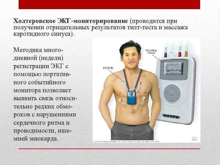 Холтеровское ЭКГ-мониторирование (проводится при получении отрицательных результатов тилт-теста и массажа каротидного синуса). Методика многодневной