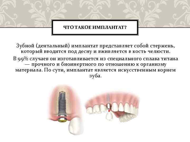 Импланты мкб. Протокол дентальной имплантации. Виды дентальной имплантации. Что представляет собой имплант зуба.