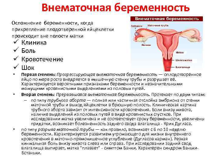  Внематочная беременность Осложнение беременности, когда прикрепление плодотверенной яйцеклетки происходит вне полости матки ü