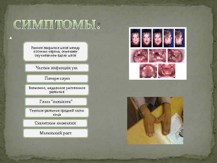 СИМПТОМЫ: Раннее закрытие швов между костями черепа, отмечают окучиванием вдоль швов Частые инфекции уха
