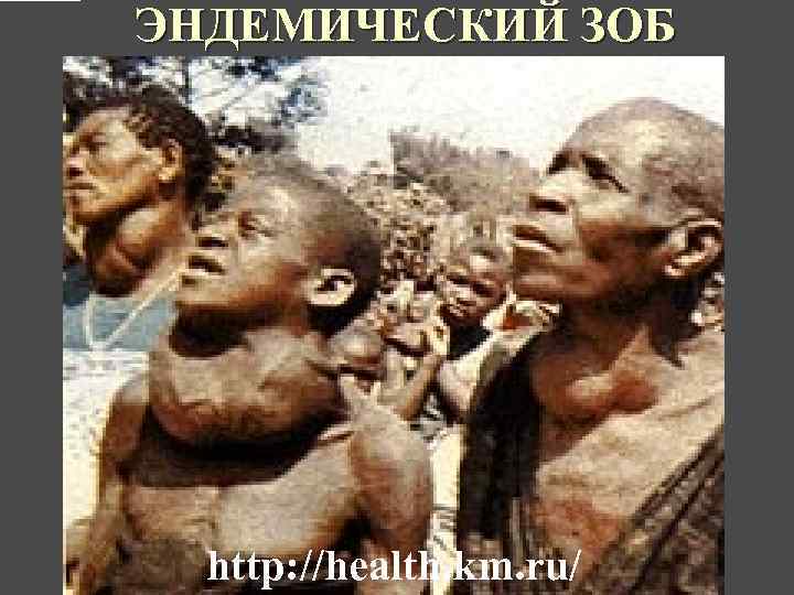 ЭНДЕМИЧЕСКИЙ ЗОБ http: //health. km. ru/ 