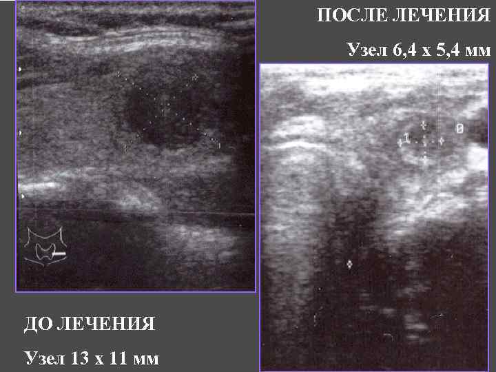 ПОСЛЕ ЛЕЧЕНИЯ Узел 6, 4 х 5, 4 мм ДО ЛЕЧЕНИЯ Узел 13 х