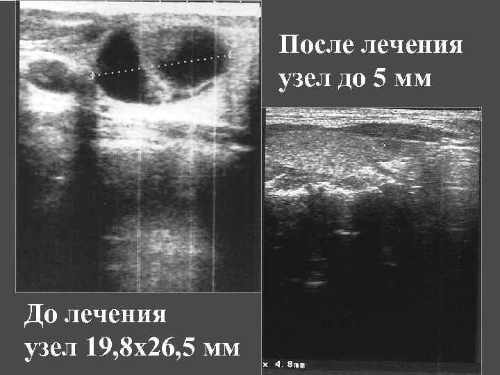 После лечения узел до 5 мм До лечения узел 19, 8 х26, 5 мм