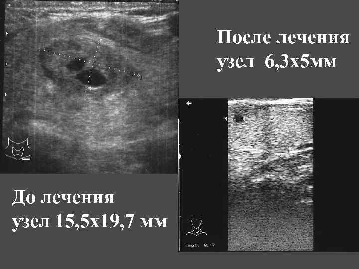 После лечения узел 6, 3 х5 мм До лечения узел 15, 5 х19, 7