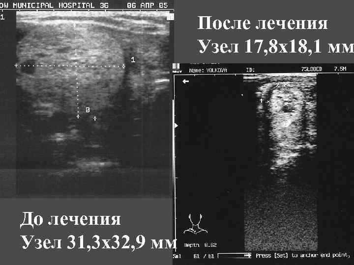 После лечения Узел 17, 8 х18, 1 мм До лечения Узел 31, 3 х32,