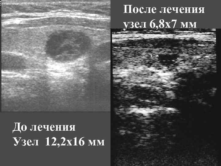 После лечения узел 6, 8 х7 мм До лечения Узел 12, 2 х16 мм