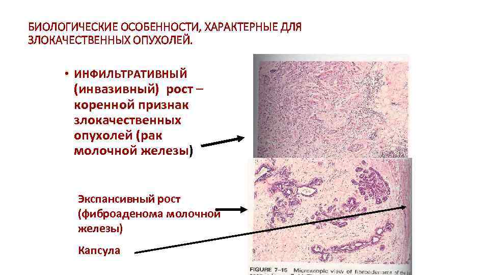 БИОЛОГИЧЕСКИЕ ОСОБЕННОСТИ, ХАРАКТЕРНЫЕ ДЛЯ ЗЛОКАЧЕСТВЕННЫХ ОПУХОЛЕЙ. • ИНФИЛЬТРАТИВНЫЙ (инвазивный) рост – коренной признак злокачественных