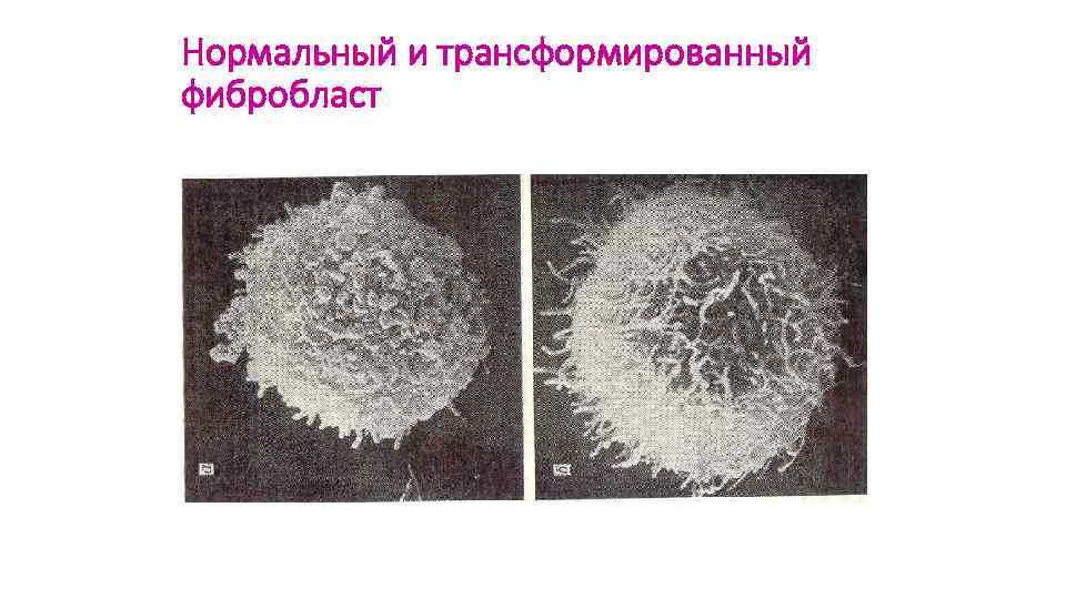 Нормальный и трансформированный фибробласт 