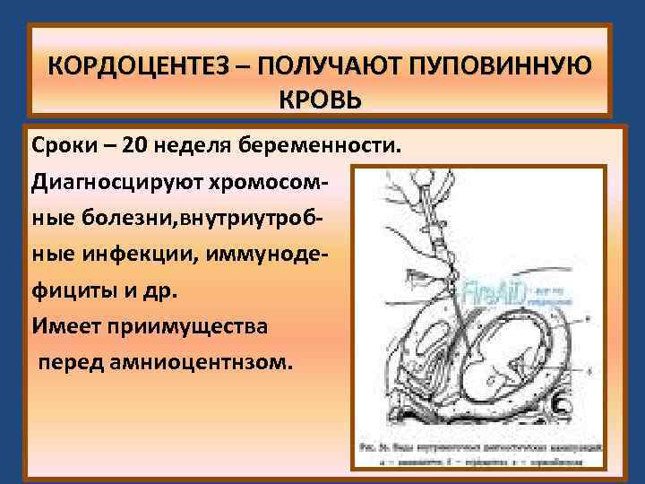 КОРДОЦЕНТЕЗ – ПОЛУЧАЮТ ПУПОВИННУЮ КРОВЬ Сроки – 20 неделя беременности. Диагносцируют хромосомные болезни, внутриутробные