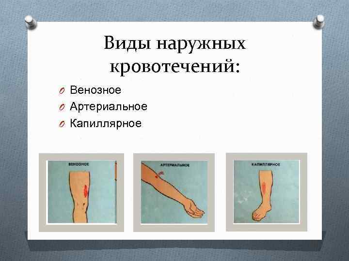 Виды наружных кровотечений: O Венозное O Артериальное O Капиллярное 