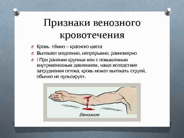 Признаки венозного кровотечения O Кровь тёмно – красного цвета O Вытекает медленно, непрерывно, равномерно