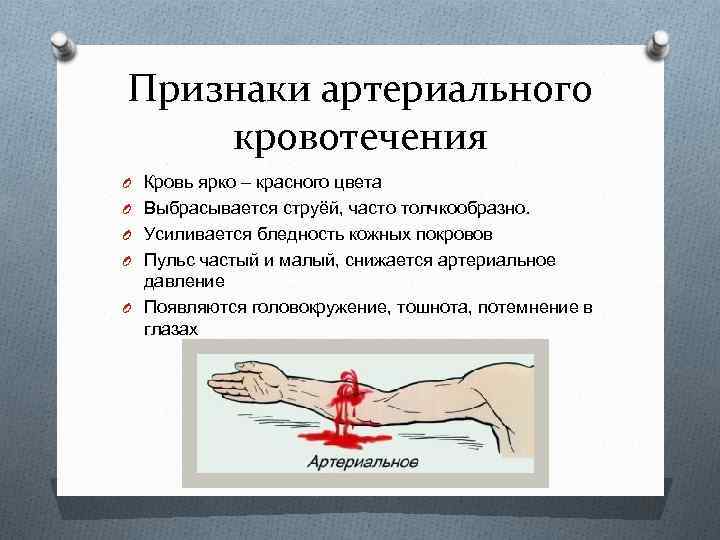 Признаки артериального кровотечения O Кровь ярко – красного цвета O Выбрасывается струёй, часто толчкообразно.